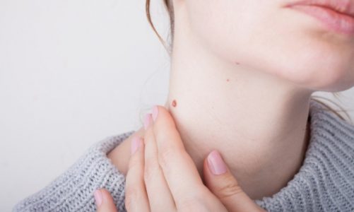 Szybka diagnoza, proste badanie – jak skutecznie walczyć z czerniakiem?